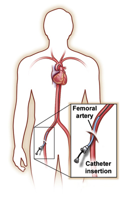 Basic Information About Angiogram And Its Utilities